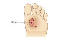 Diabetic Foot Ulcers