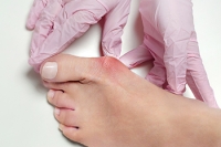 Treatment and Complications of Bunions