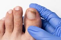 Causes of Toenail Fungus