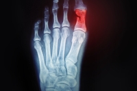 All About Toe Fractures